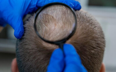Alopecia areata: Jak ji poznat a co s ní můžete dělat