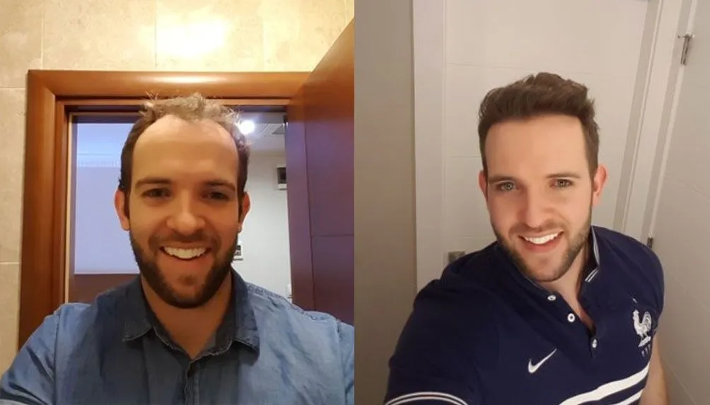 jak-pecovat-o-transplatovane-vlasy jak-pecovat-o-transplatovane-vlasy