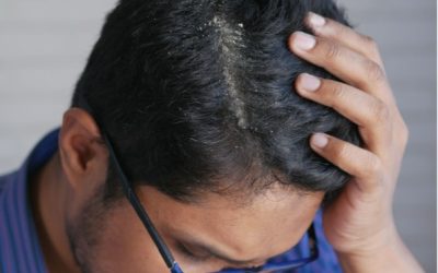 Lupy, nebo seborea? Jak poznat rozdíl a kdy problém řešit odborně